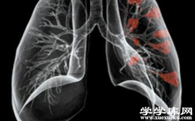 支气管肺炎的症状 支气管肺炎如何鉴别